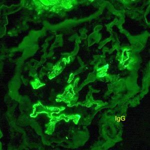 IgG Membranous glomerulopathy stain of renal biopsy