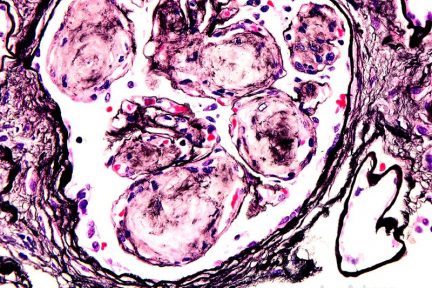 Light Chain Deposition Disease