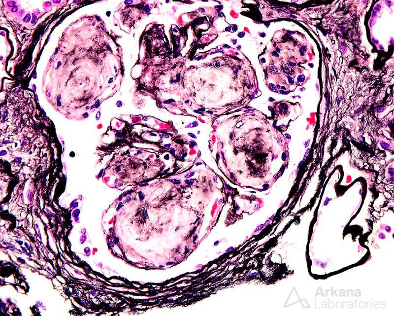 Light Chain Deposition Disease