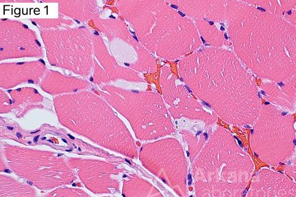 Tubular aggregates in H&E stain of muscle/nerve biopsy