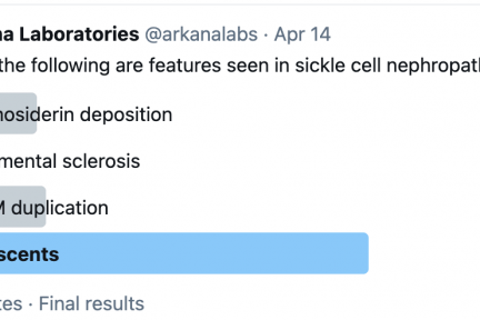 sickle cell nephropathy, Crescents