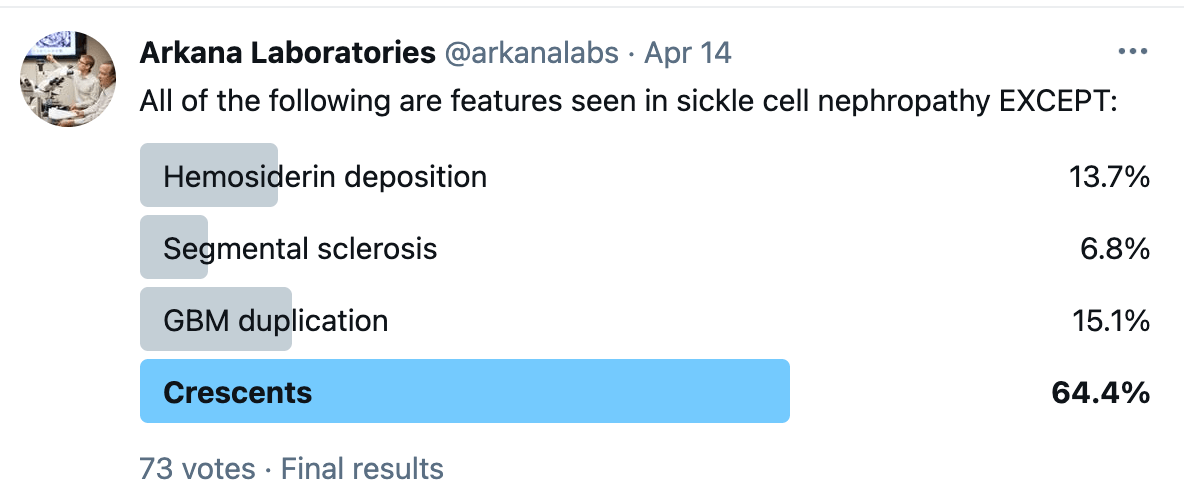 sickle cell nephropathy, Crescents