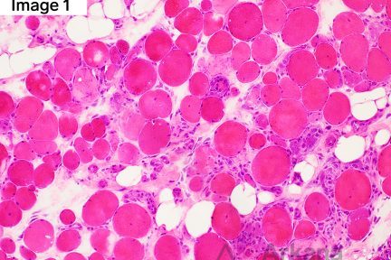 Anti-SRP Myopathy in neuro muscle biopsy