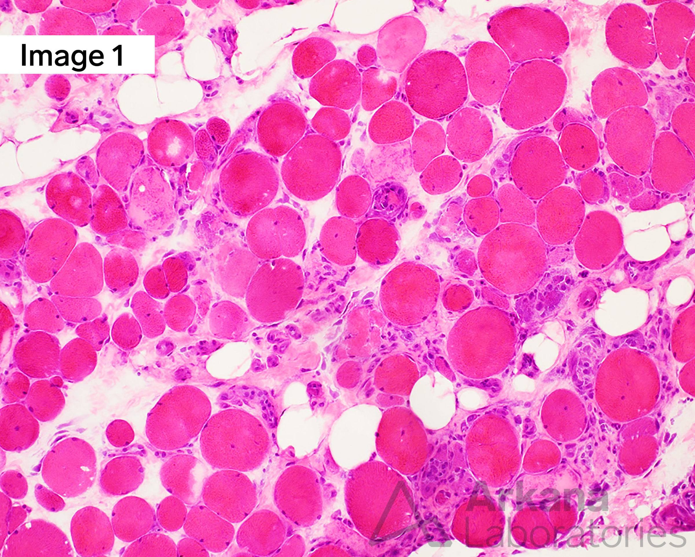 Anti-SRP Myopathy in neuro muscle biopsy