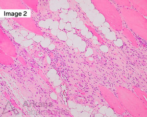 Anti-SRP Myopathy in muscle fiber biopsy