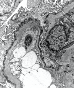 EM Images for renal pathology