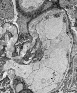 renal pathology images, EM images for renal path