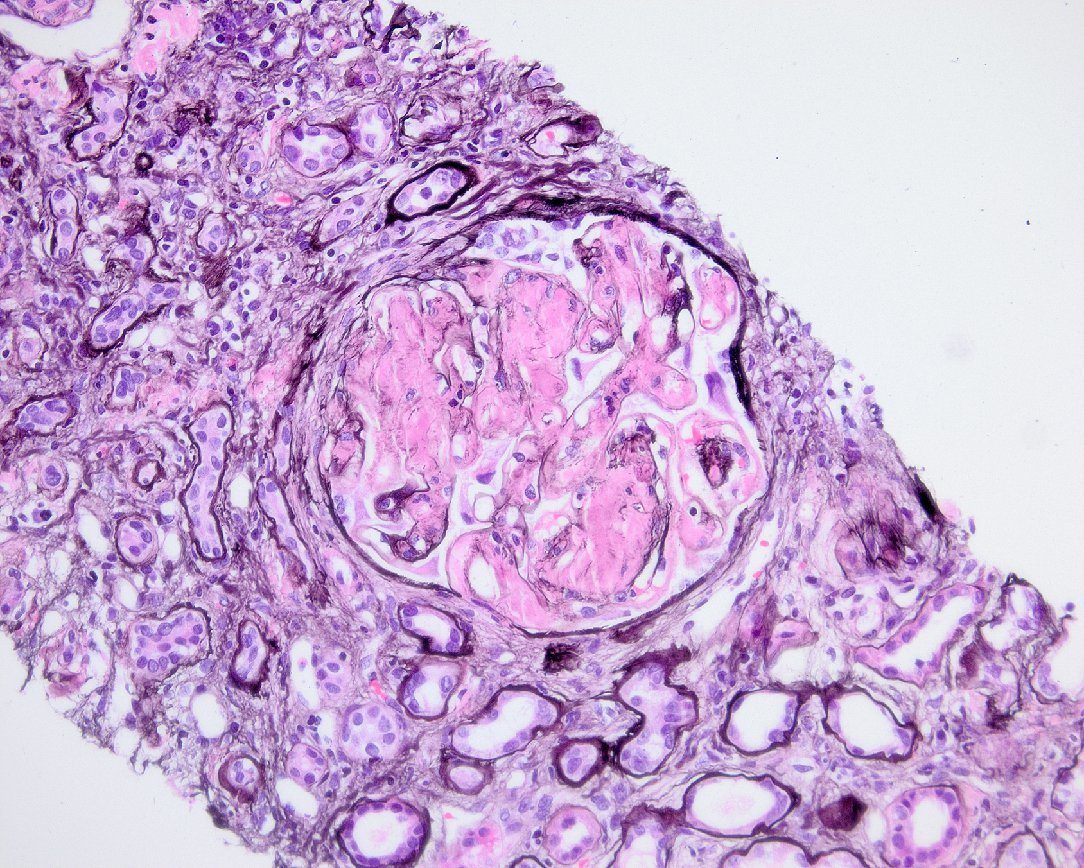 AA Amyloid Diagnosis in Renal Biopsy