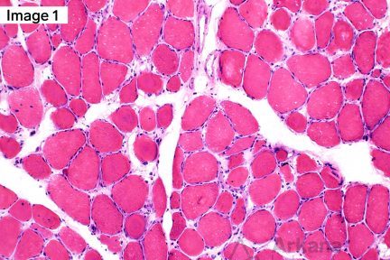 Myotonic Dystrophy Type 2