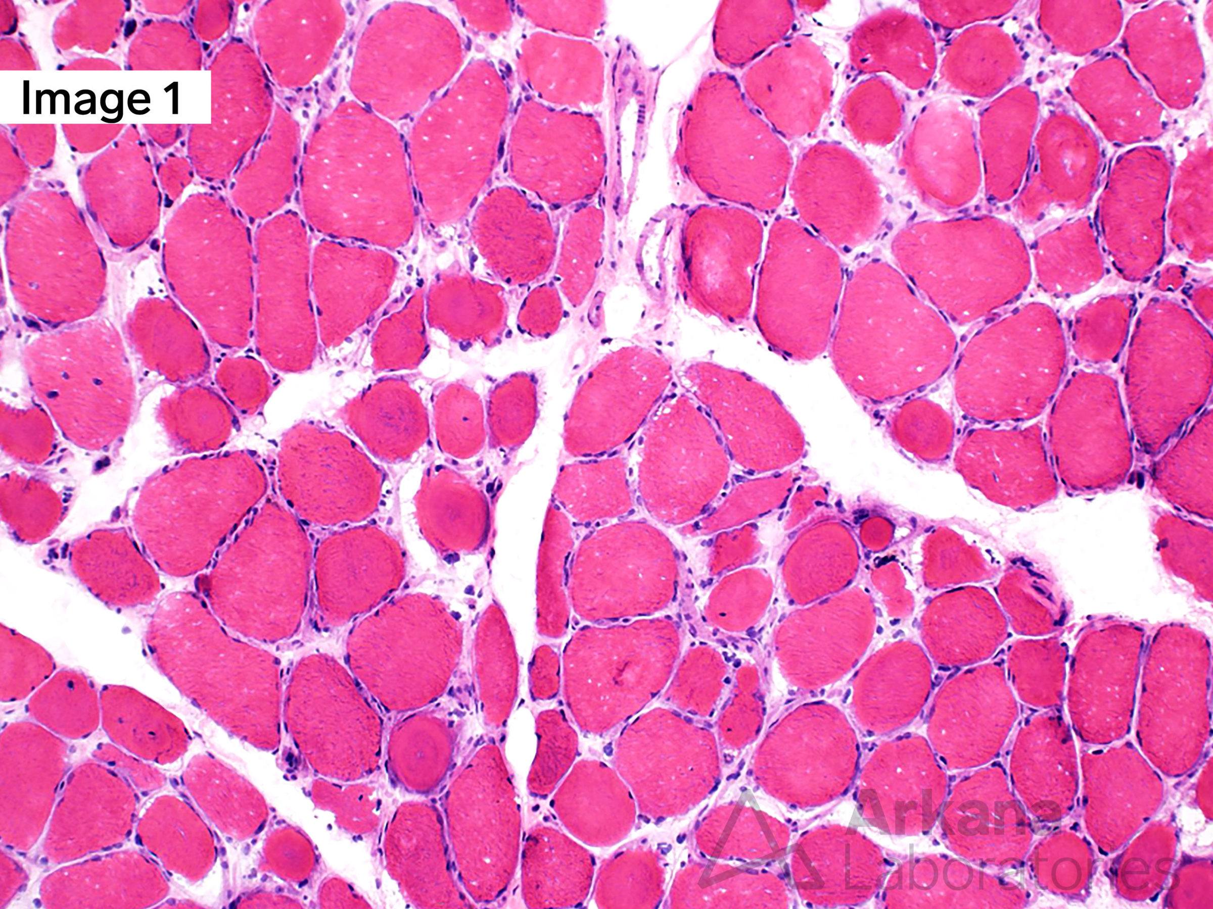 Myotonic Dystrophy Type 2