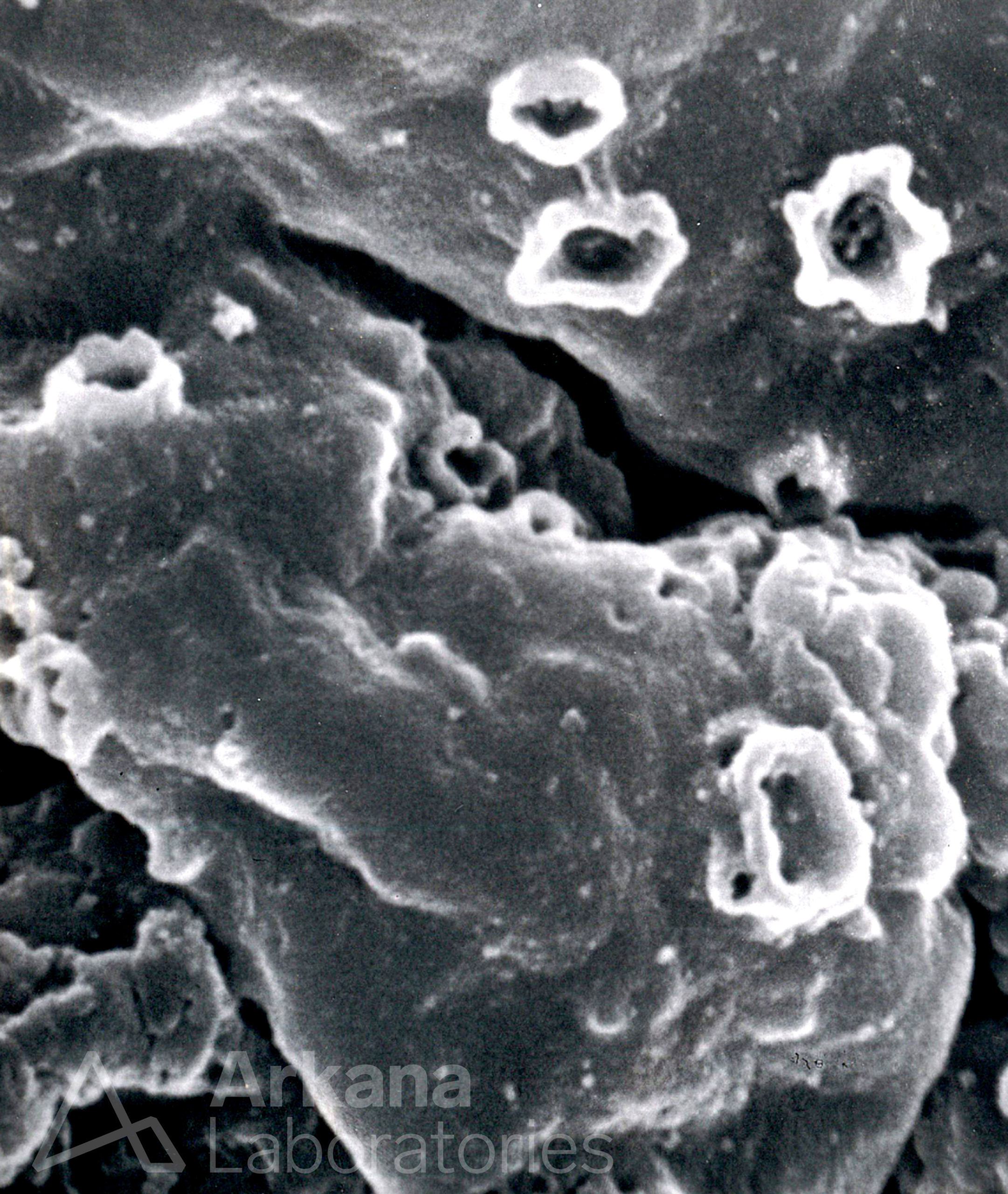 Craters on Glomerular Basement Membranes from a renal biopsy with membranous glomerulonephritis