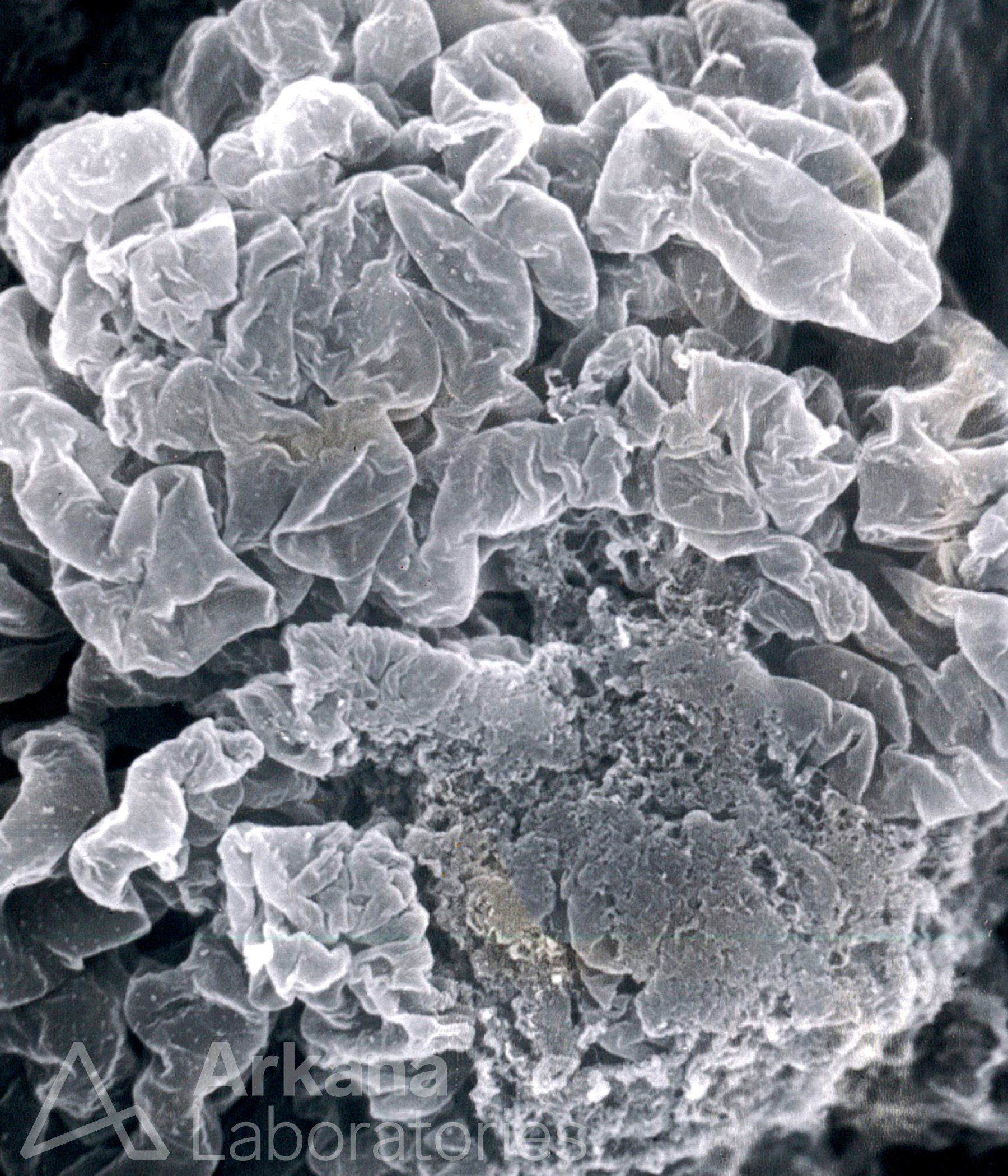 Normal Glomerular Tuft with Segmental Necrosis, eyeSCANdy, Arkana Laboratories