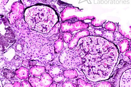 juxtaglomerular apparatus hyperplasia in renal biopsy at Arkana Laboratories