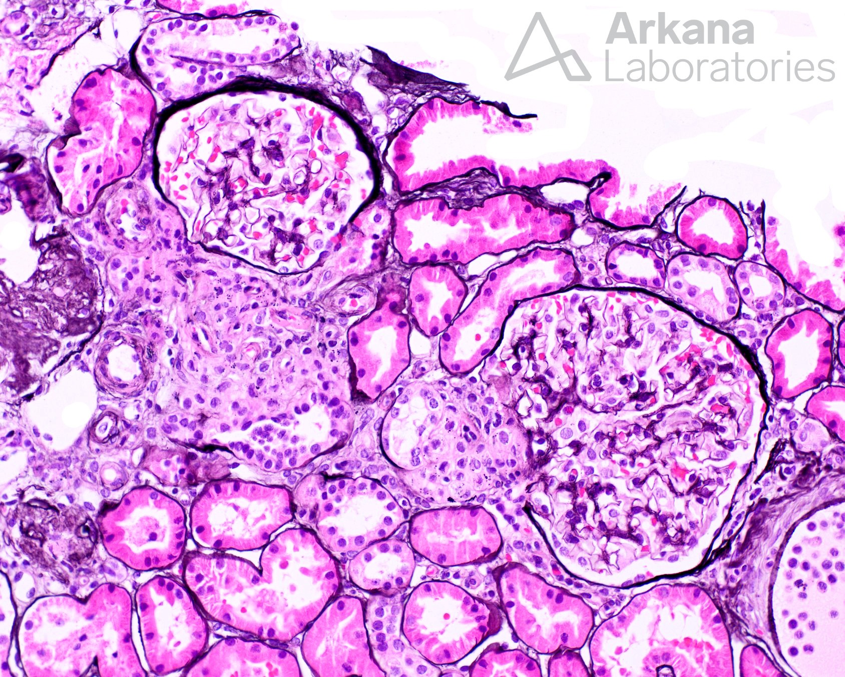 juxtaglomerular apparatus hyperplasia in renal biopsy at Arkana Laboratories