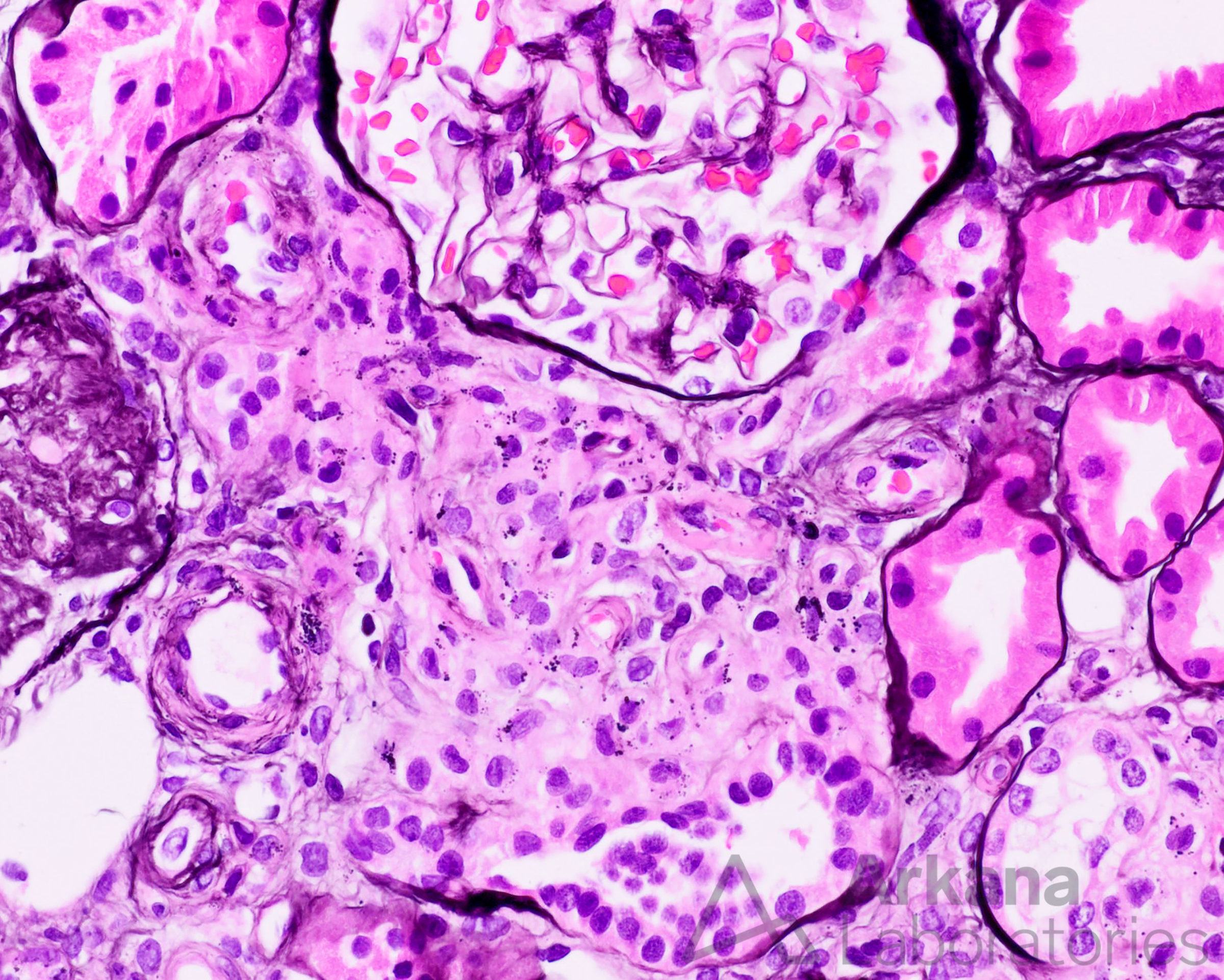 juxtaglomerular apparatus hyperplasia in renal biopsy at Arkana Laboratories