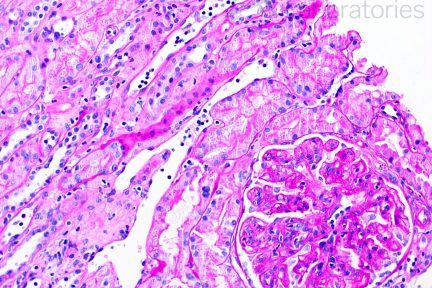 hronic active antibody-mediated rejection biopsy at arkana laboratories