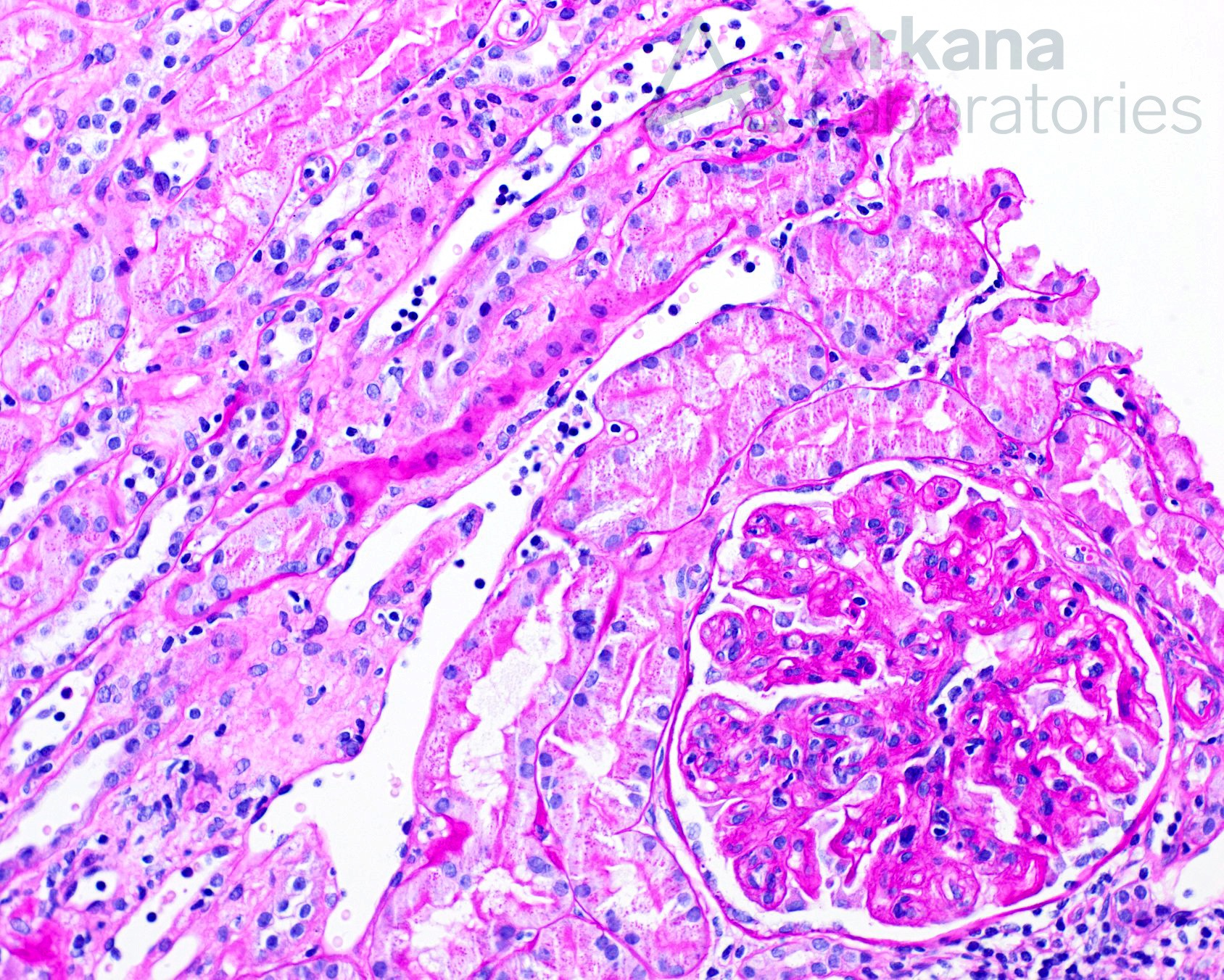 hronic active antibody-mediated rejection biopsy at arkana laboratories