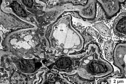 diffuse foot process effacement, Minimal change disease, Nephrotic syndrome, Podocytopathy, Arkana Laboratories