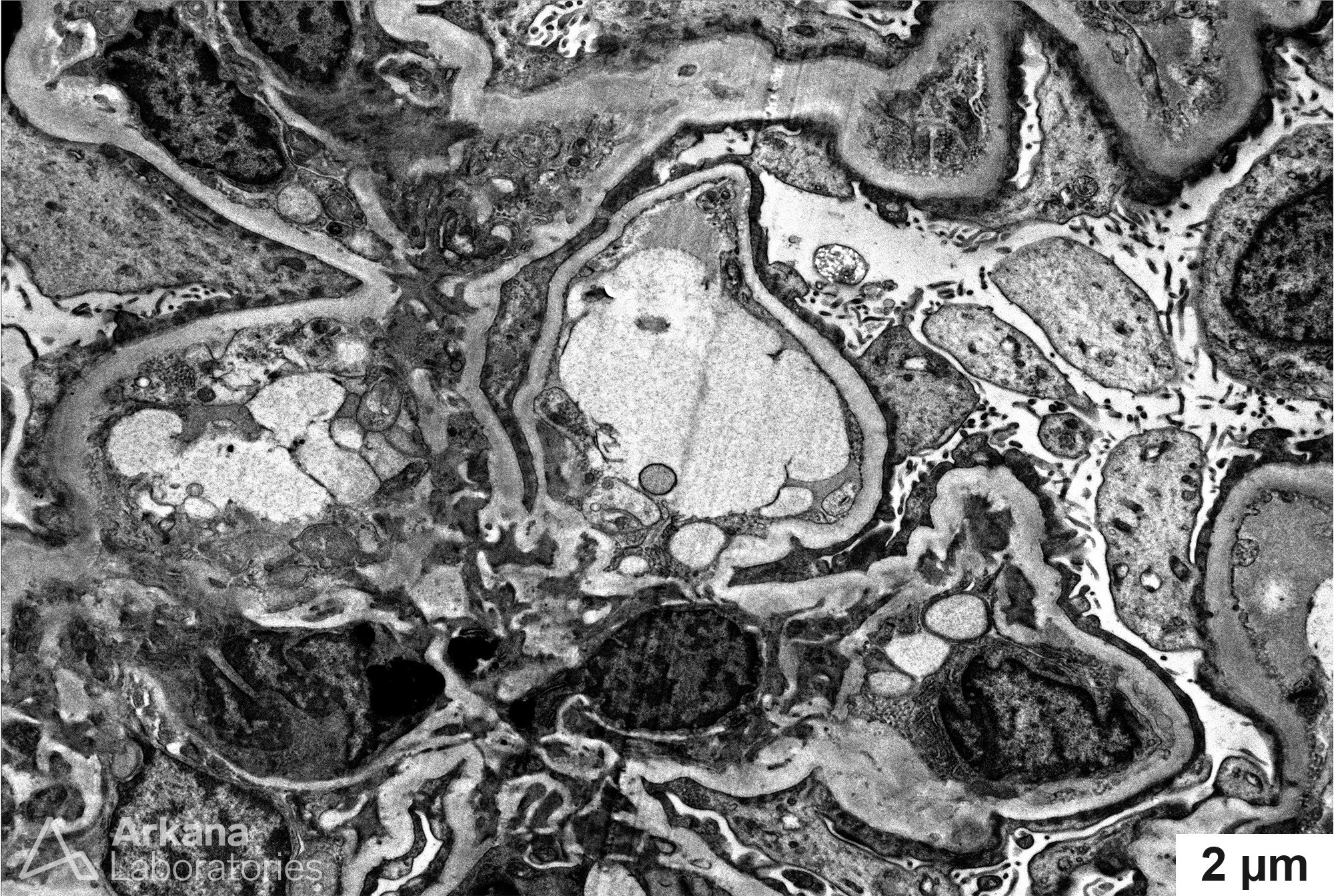 diffuse foot process effacement, Minimal change disease, Nephrotic syndrome, Podocytopathy, Arkana Laboratories