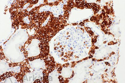 intravascular large B-cell lymphoma (LBCL) in renal biopsy at Arkana Laboratories