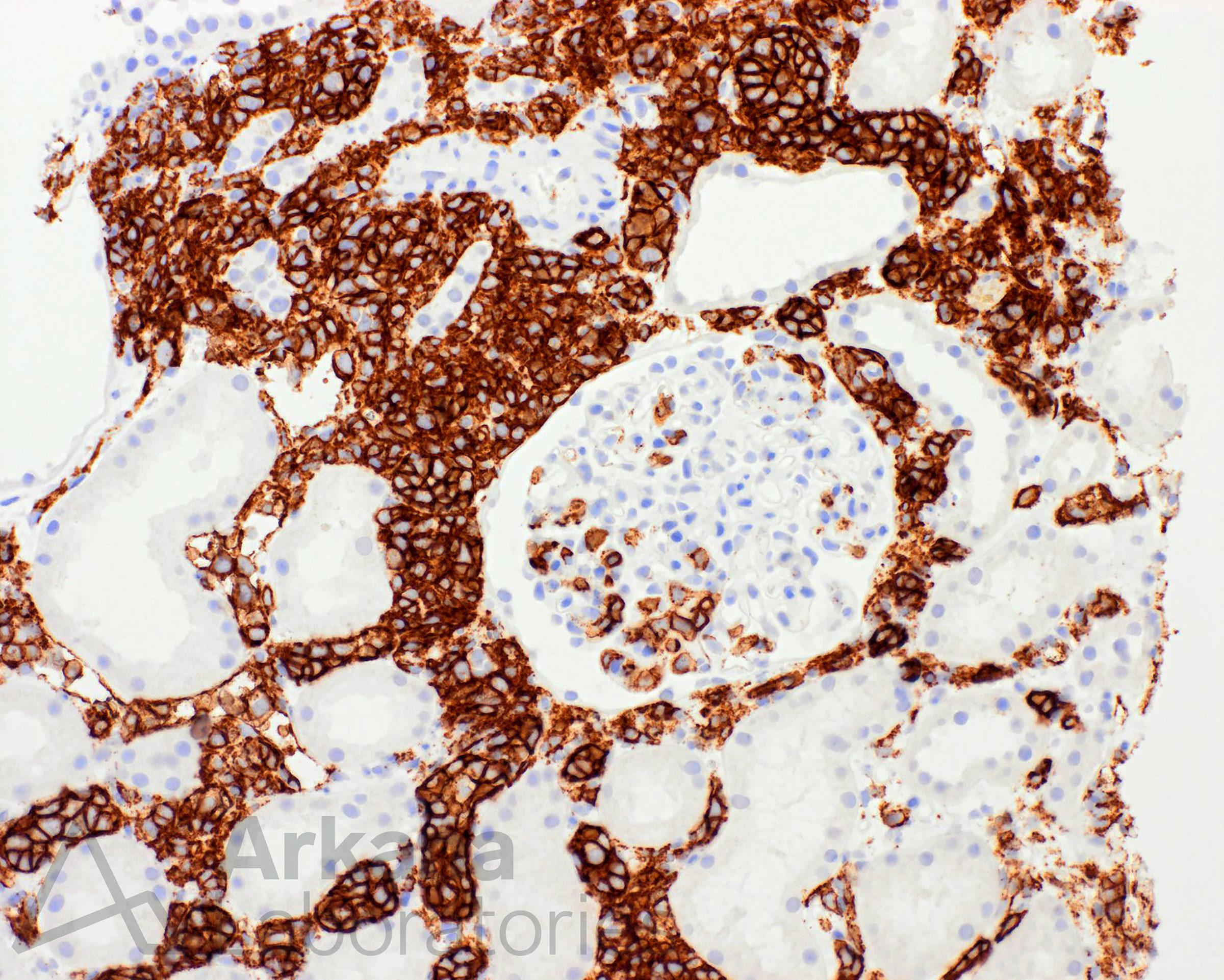 intravascular large B-cell lymphoma (LBCL) in renal biopsy at Arkana Laboratories