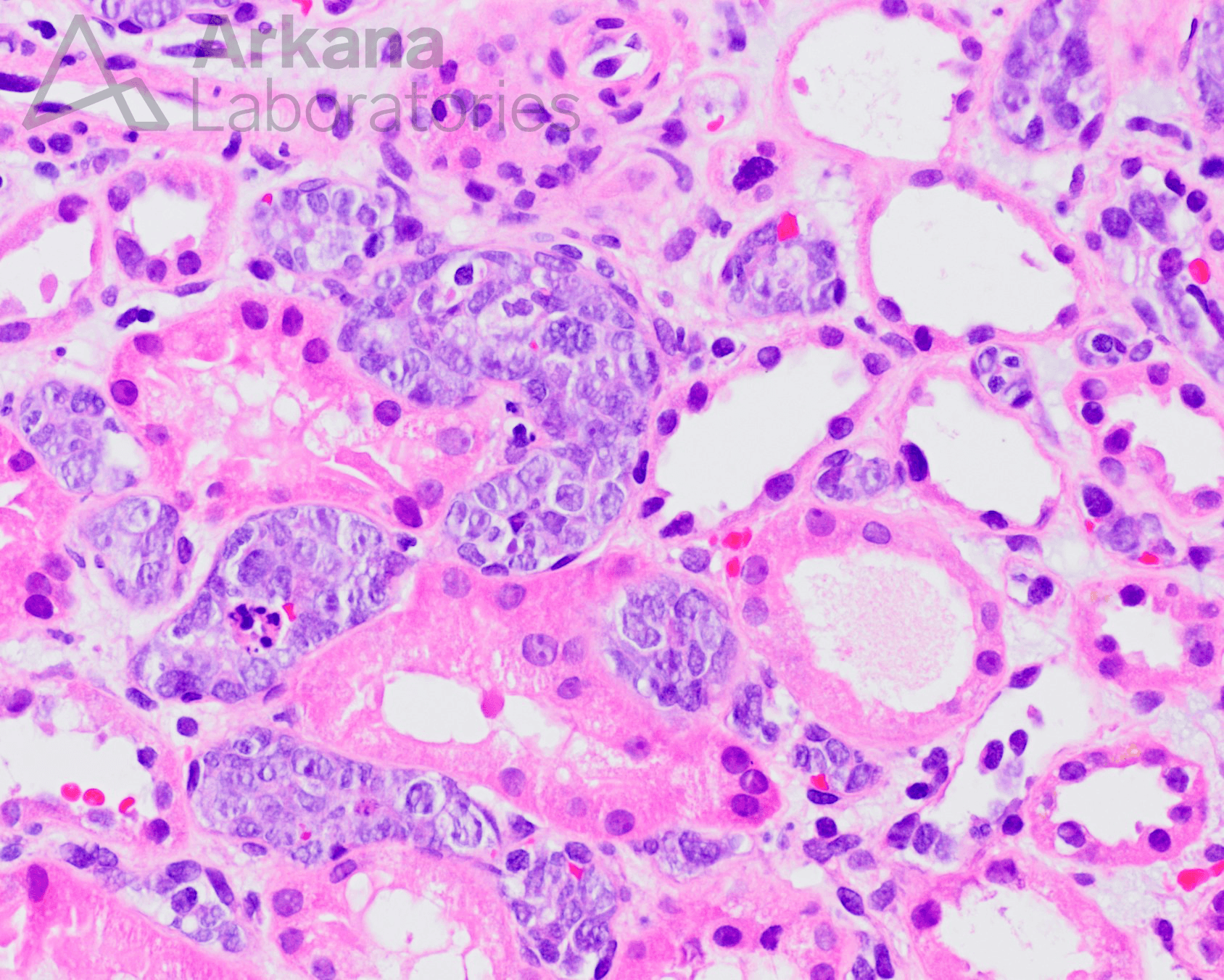 large B-cell lymphoma H&E Stain