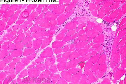 U1-RNP-Related Myositis/Myopathy