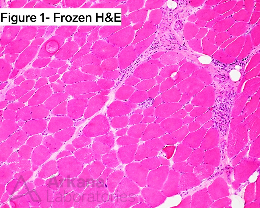 U1-RNP-Related Myositis/Myopathy