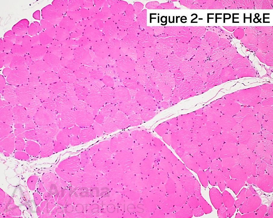 U1-RNP-Related Myositis/Myopathy