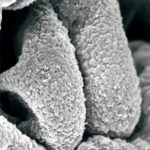 Subepithelial Immune Deposits Carpeting GBM Surface