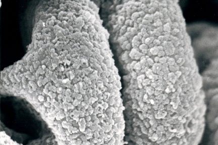 subepithelial immune deposits, eyeSCANdy, renal pathology