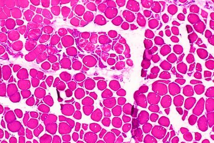 C9orf72 gene, neuronotes, neropathology