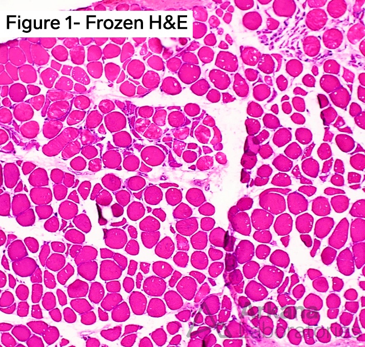 C9orf72 gene, neuronotes, neropathology