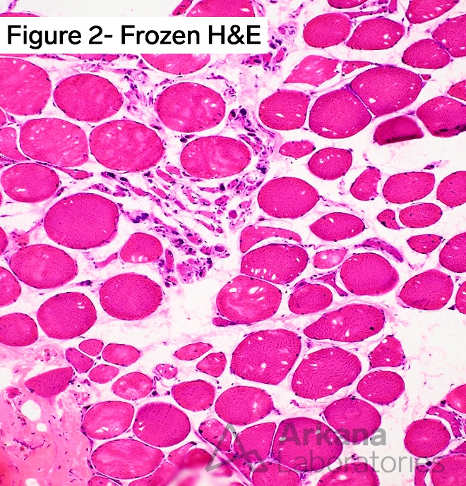 9 open reading frame 72 gene (C9orf72 gene), frozen h&e stain