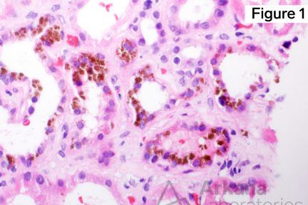 sickled cell within a glomerular capillary