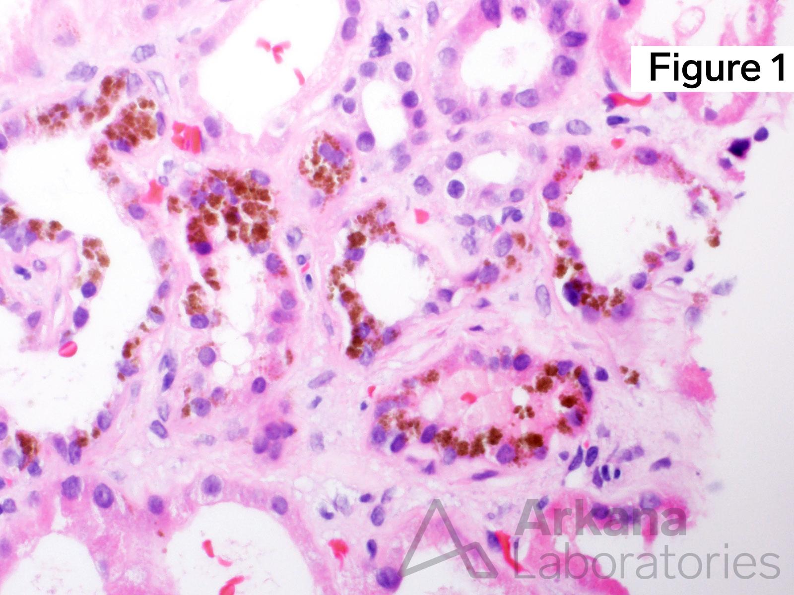 sickled cell within a glomerular capillary