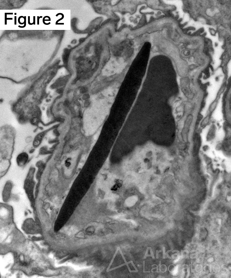 sickled cell within a glomerular capillary