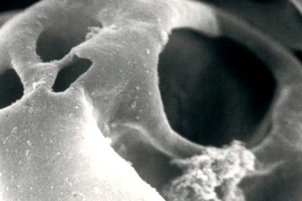 GBM Injury in Crescentic GN