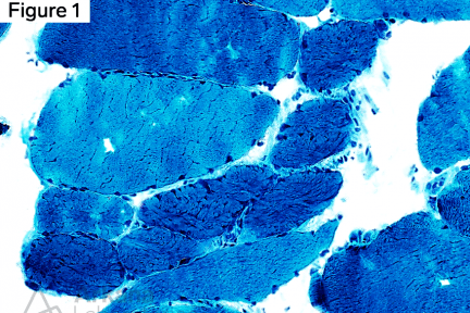 Myopathy with Lobulated Muscle Fibers