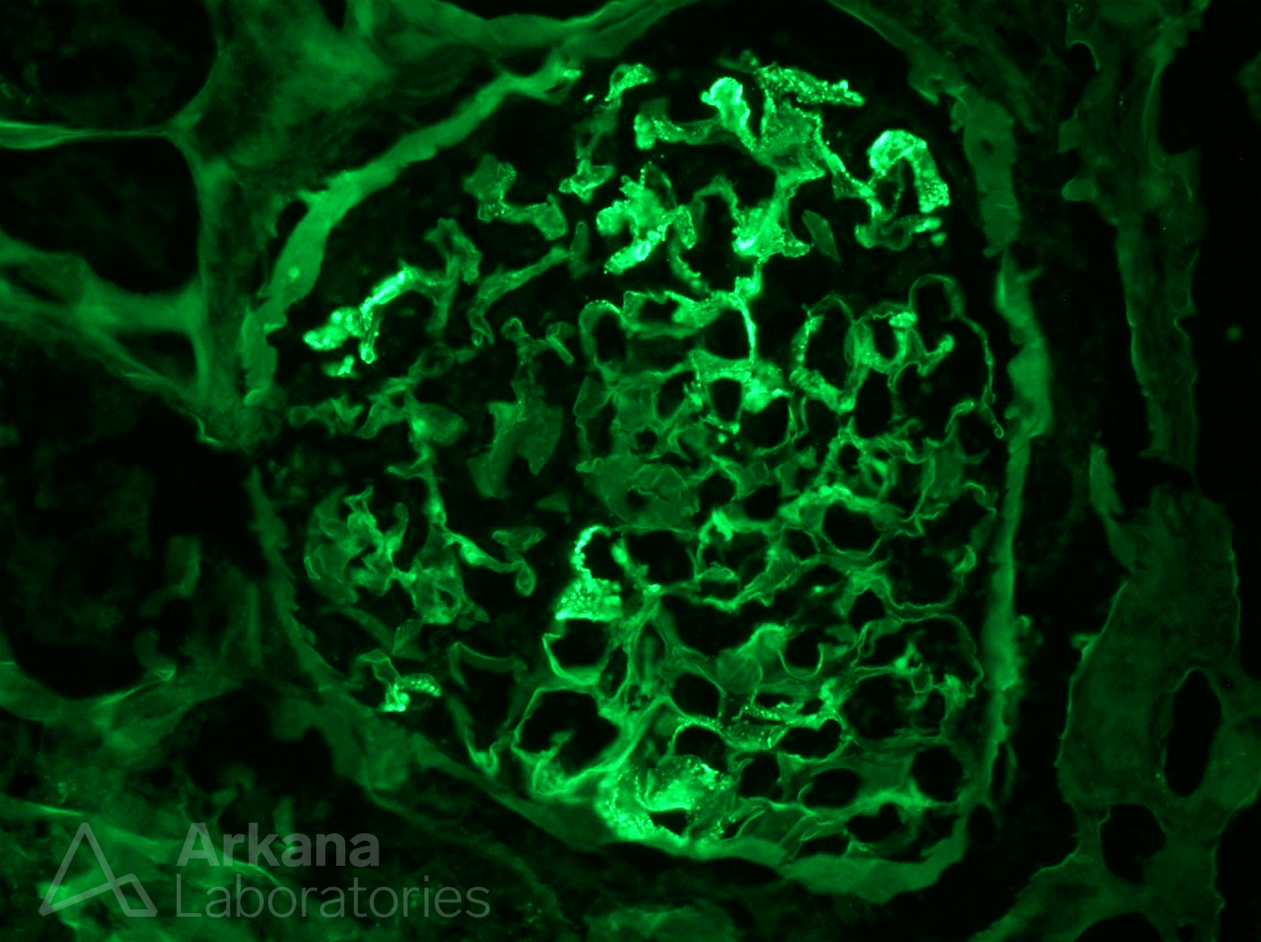 segmental membranous nephropathy (MN) Art of Medicine painting