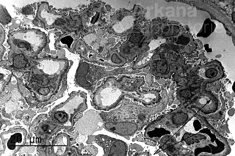 segmental membranous nephropathy (MN) Art of Medicine painting