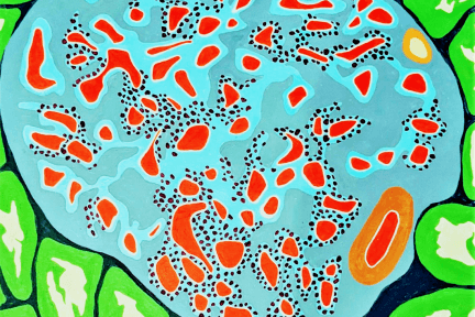 segmental membranous nephropathy (MN) Art of Medicine painting