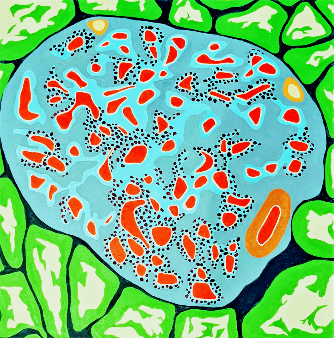 segmental membranous nephropathy (MN) Art of Medicine painting