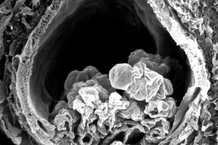 Glomerulus with Ischemic Collapse