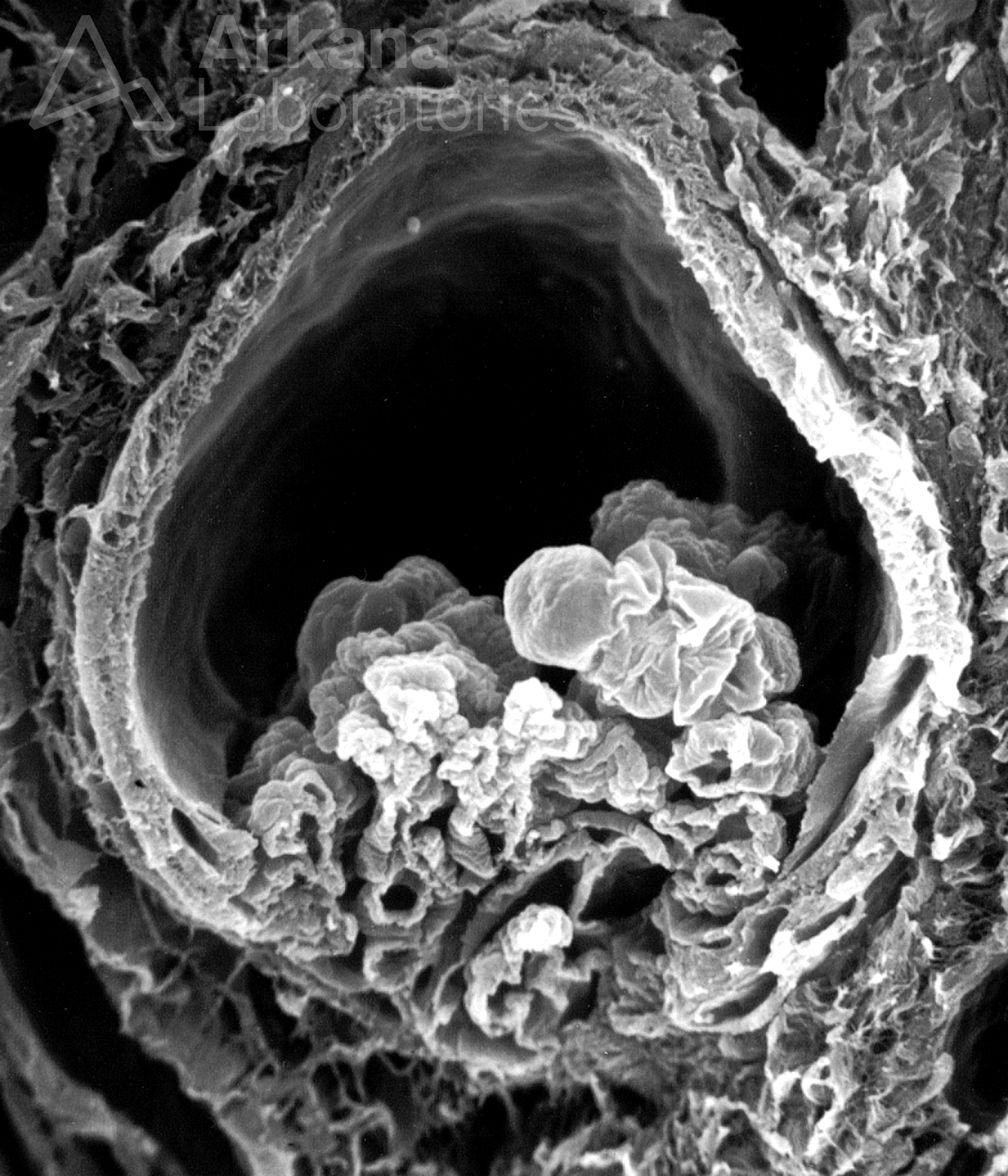 Glomerulus with Ischemic Collapse