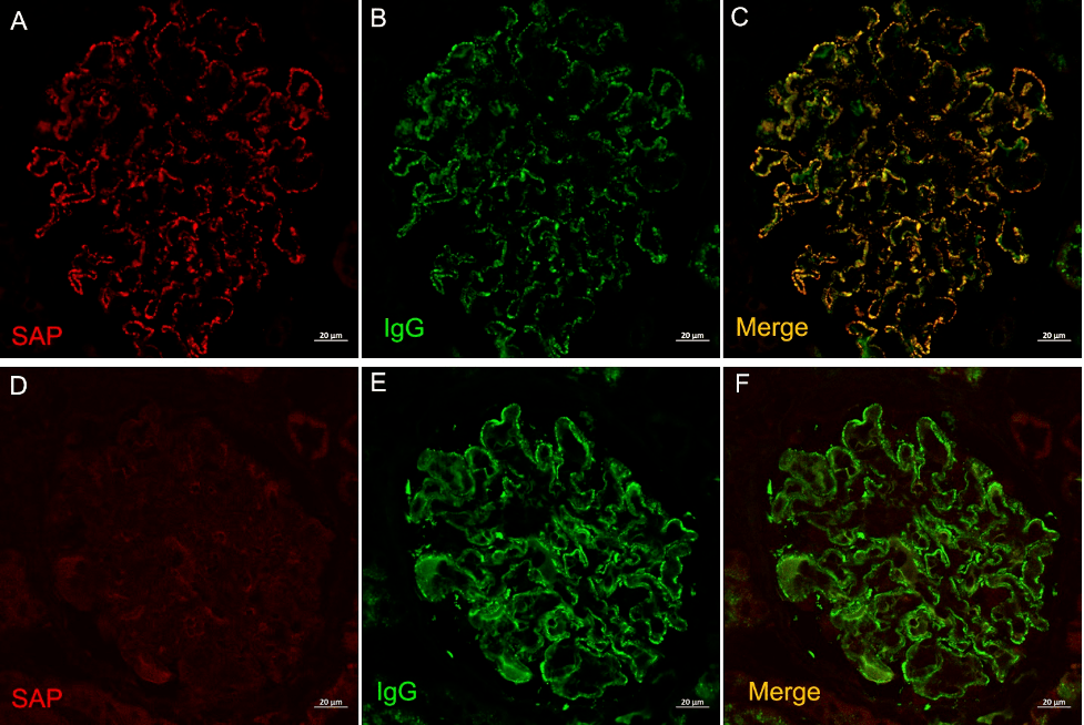 Laser capture microdissection followed by mass spectrometry identified serum amyloid P (SAP) as uniquely present within glomeruli in MGMID. 