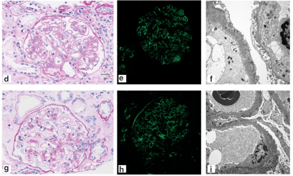 Here’s C3 glomerulopathy (top) and PLA2R-positive MN (bottom), and you can notice identical light, standard IF, and EM findings that occur in MGMID. 