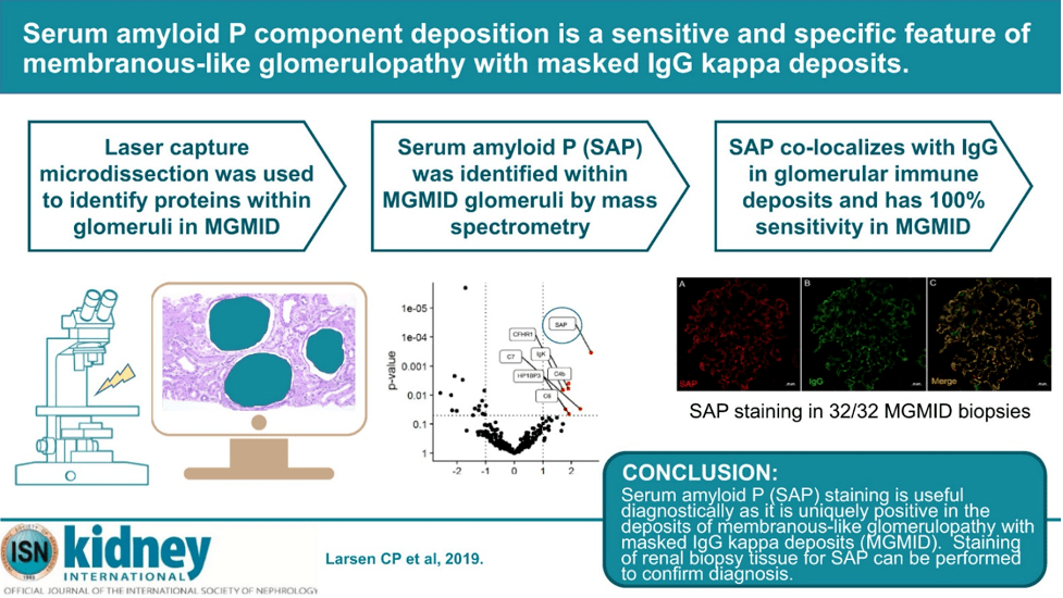 SAP staining by paraffin immunofluorescence of kidney biopsies is a useful diagnostic tool for MGMID, which is both sensitive and specific. 