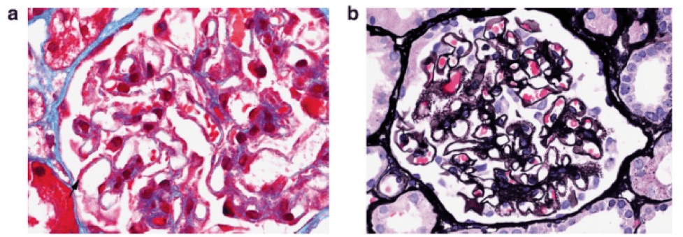 On light microscopy, the glomerular capillary loops appear prominent and there are fuscinophilic deposits on trichrome stain (a) and may be the formation of spikes and holes on silver stains (b), as also seen in membranous glomerulopathy (it’s membranous-like). 