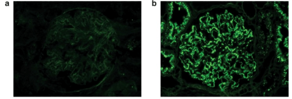 IgG is negative in a majority of cases (a). However, pronase digestion on FFPE tissue will lead to “unmasking” of immune deposits, which will be positive along the glomerular capillary loops and frequently also within the mesangium (b). 